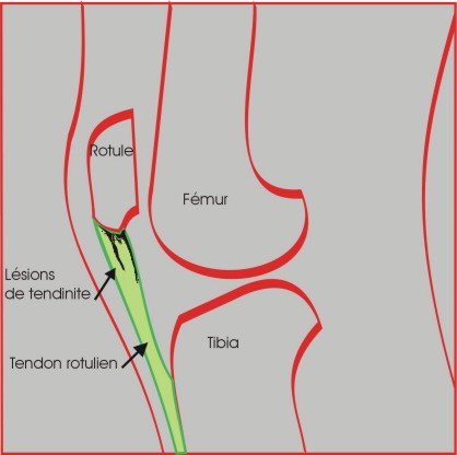 Symptômes et diagnostic de la tendinite du talon rotulien